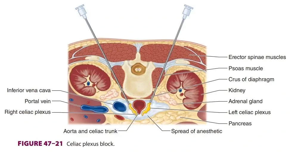 celiac plexus block procedure